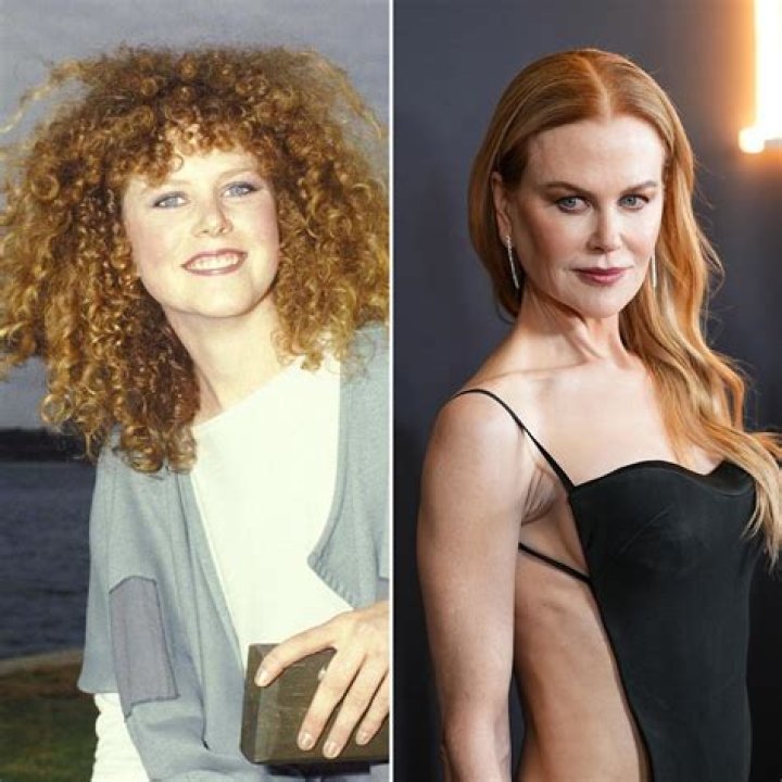 Nicole Kidman before and after plastic surgery (18) Celebrity plastic