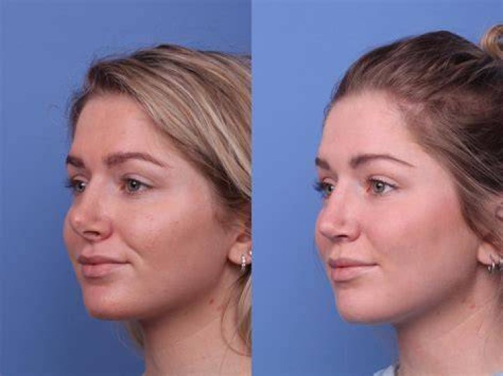 Pin auf Plastic Surgery Before and After